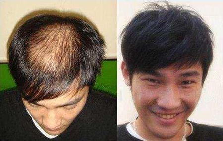 男人头发稀少,怎么变浓密?