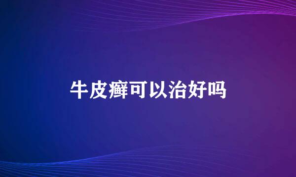 牛皮癣可以治好吗