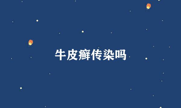 牛皮癣传染吗